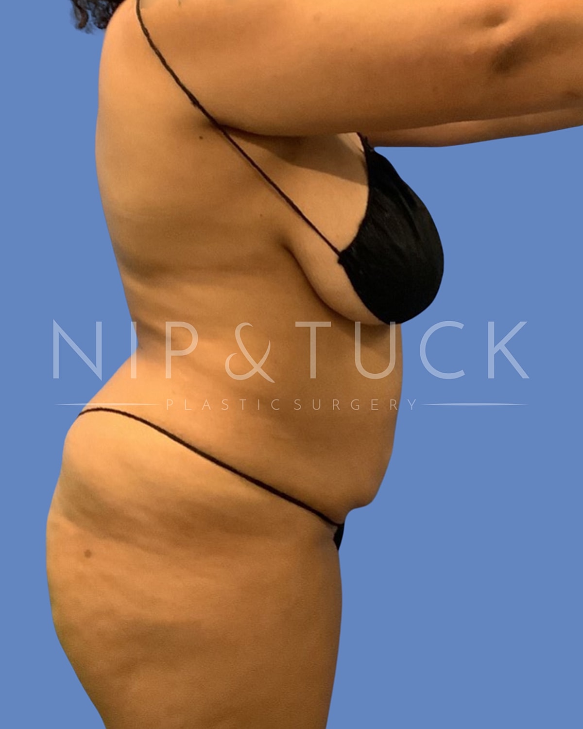 Brazilian Butt Lift Before & After