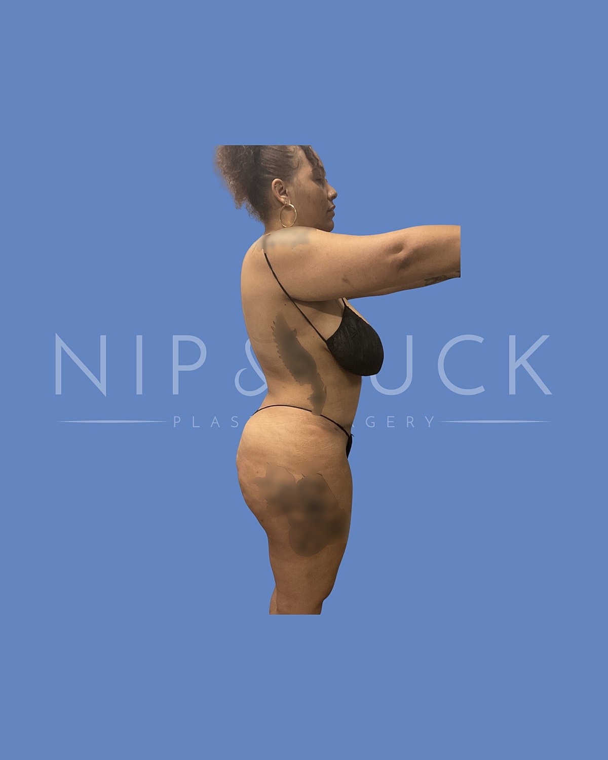 Brazilian Butt Lift Before & After