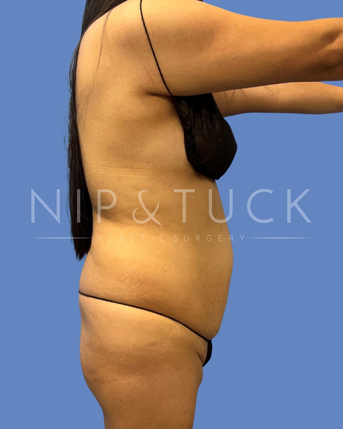 Brazilian Butt Lift Before & After