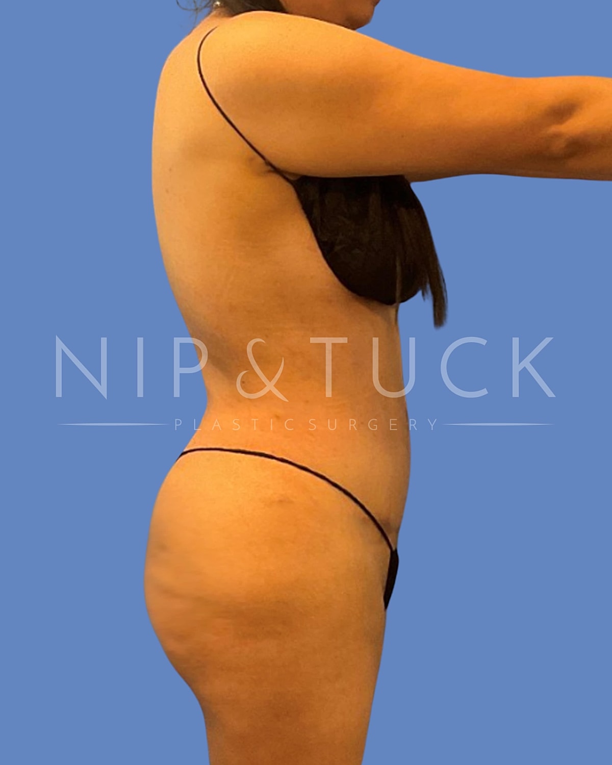 Brazilian Butt Lift Before & After