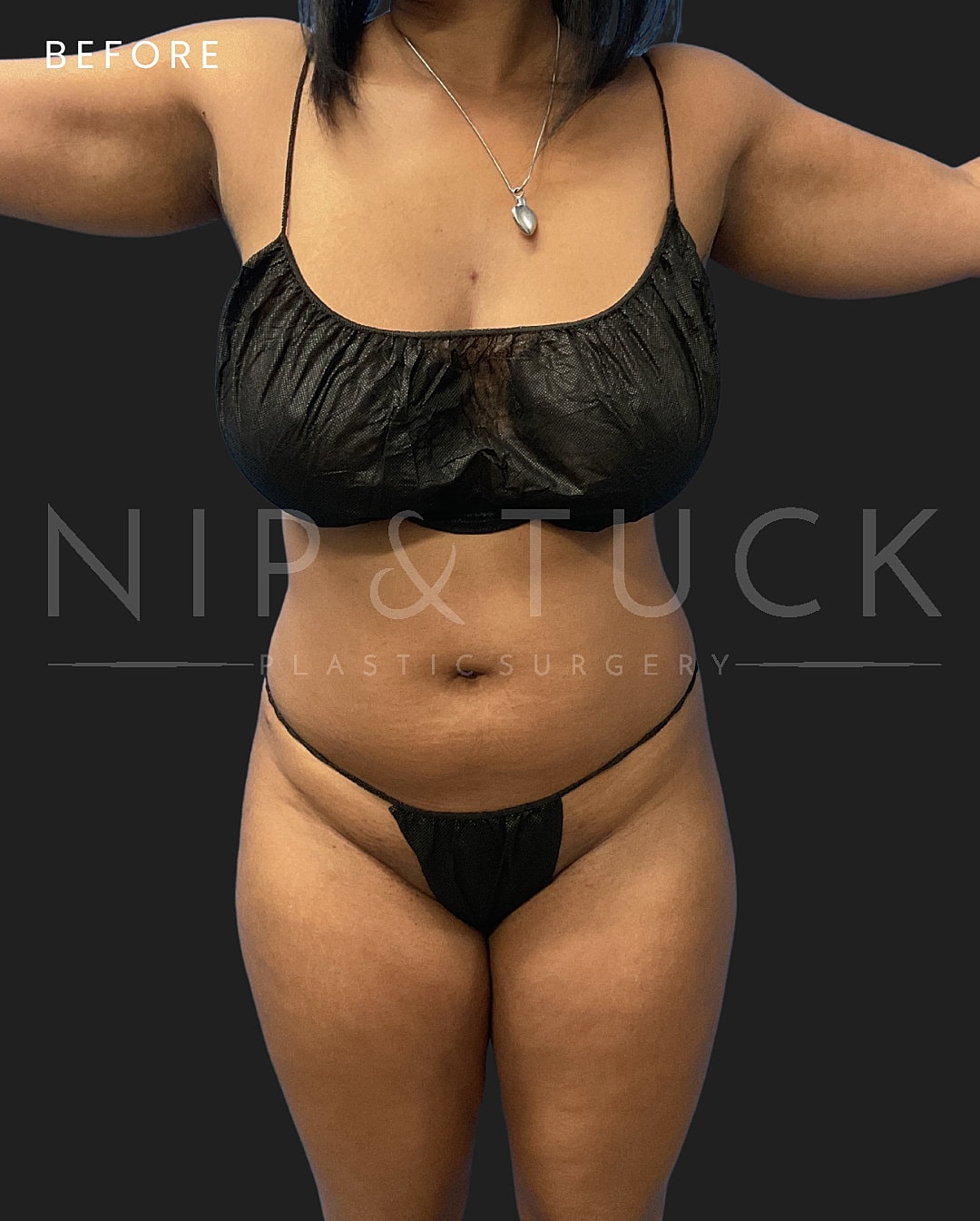 Brazilian Butt Lift Before & After