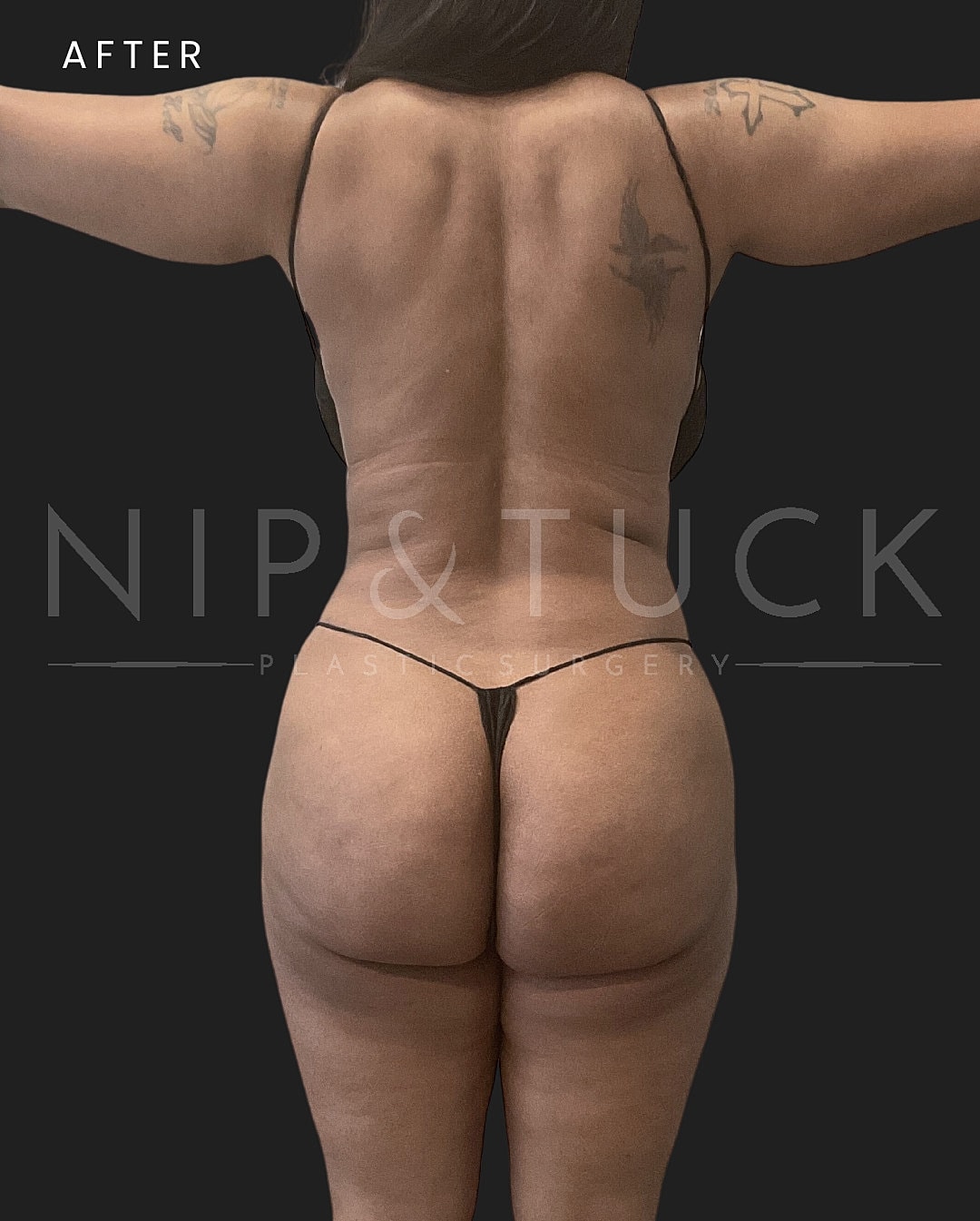 Brazilian Butt Lift Before & After