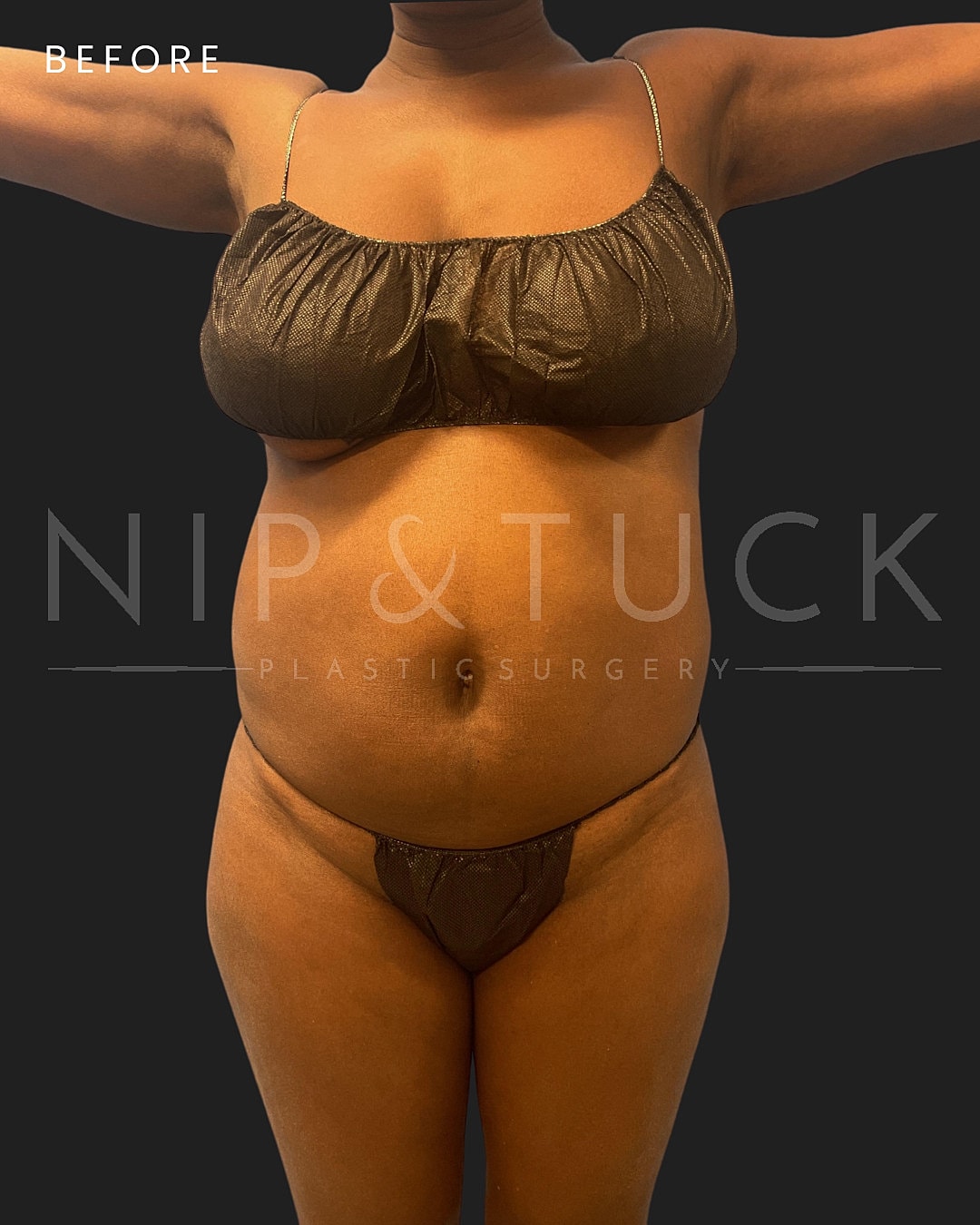 Brazilian Butt Lift Before & After