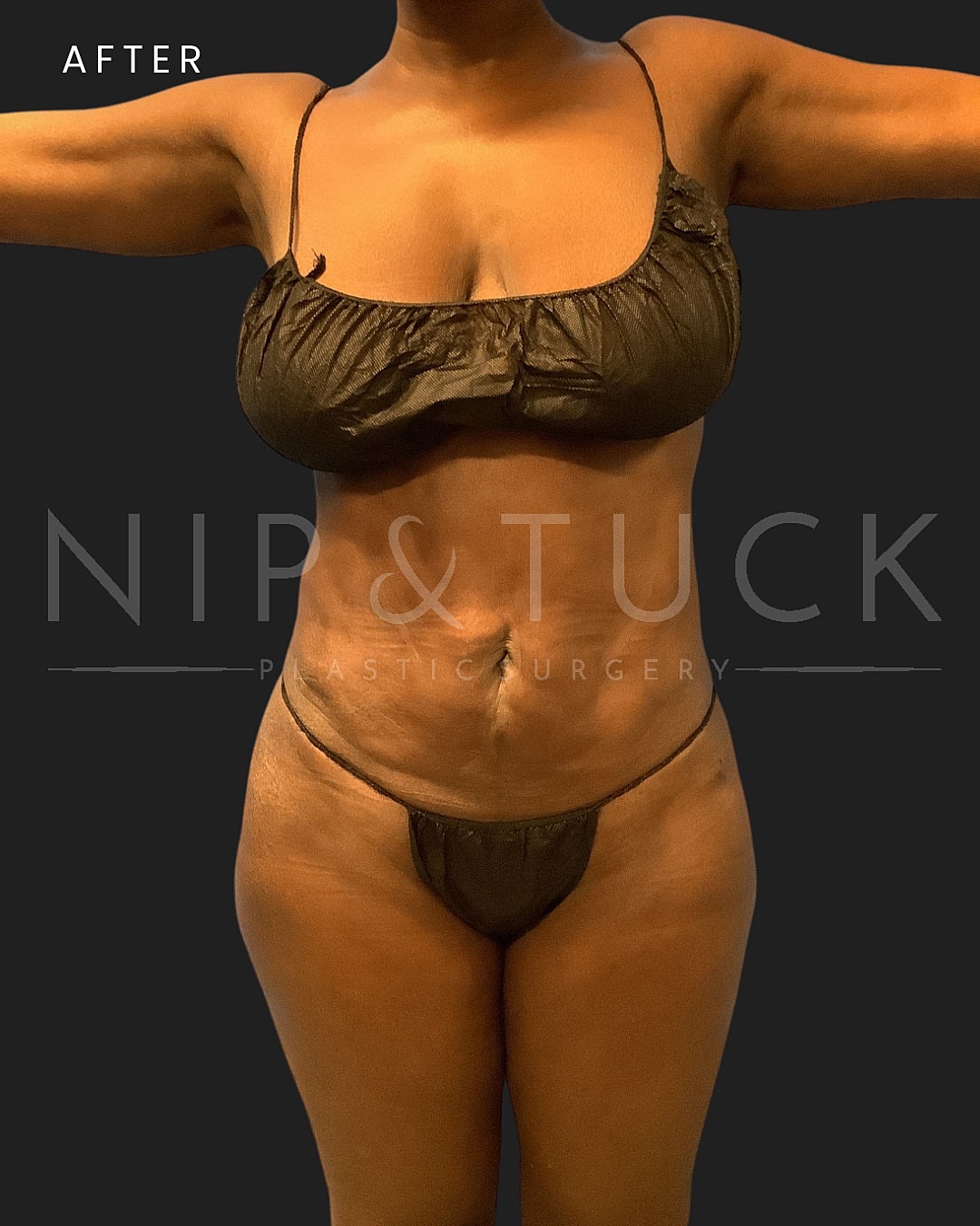 Brazilian Butt Lift Before & After
