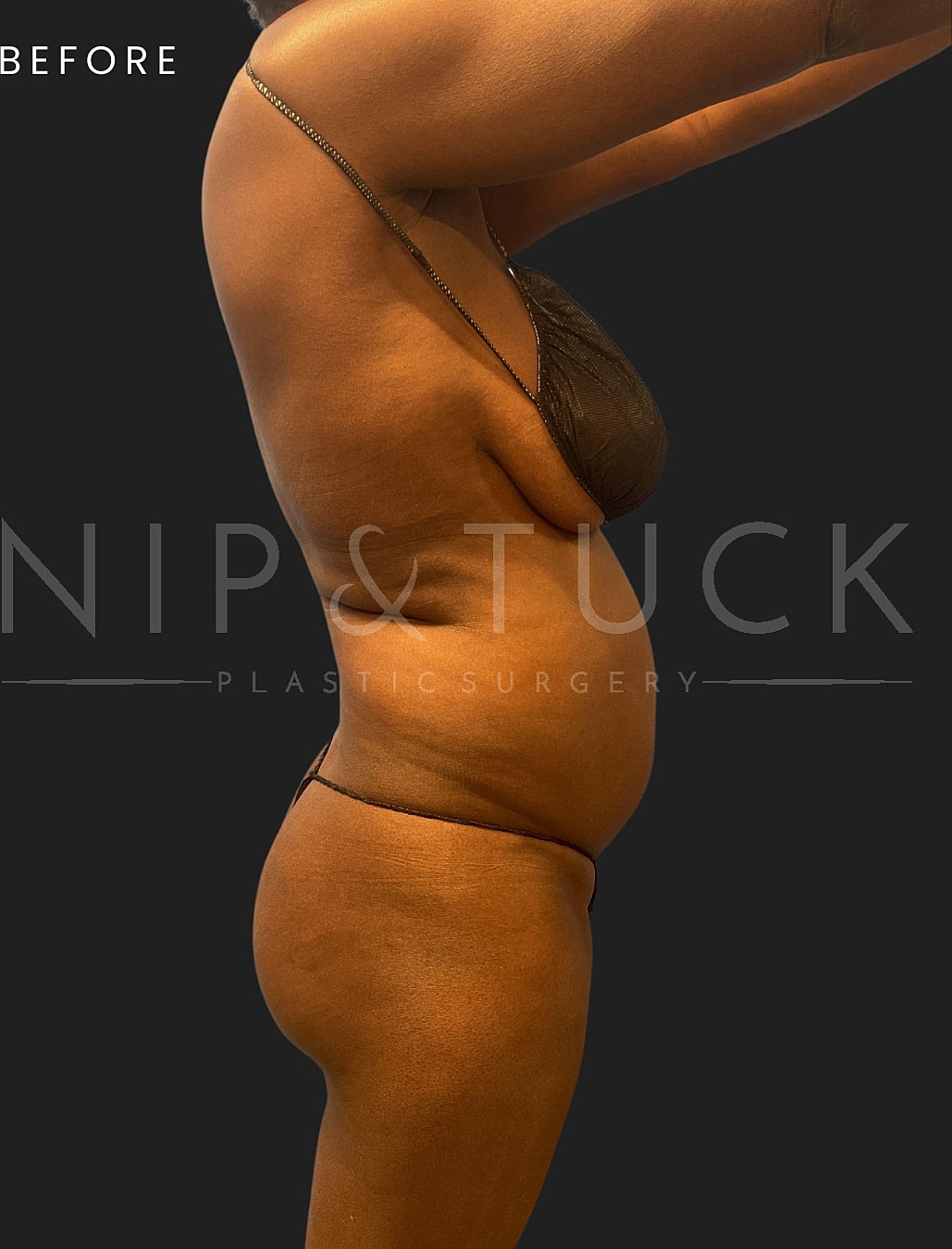Brazilian Butt Lift Before & After