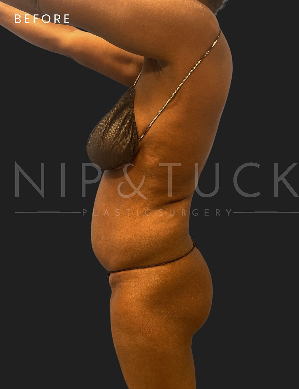 Brazilian Butt Lift Before & After