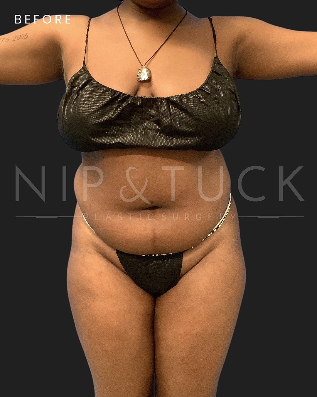 Brazilian Butt Lift Before & After