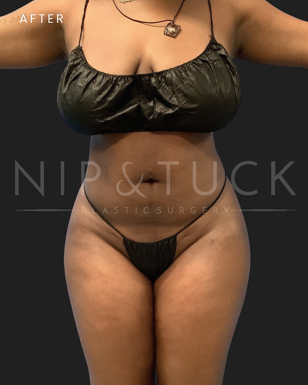 Brazilian Butt Lift Before & After