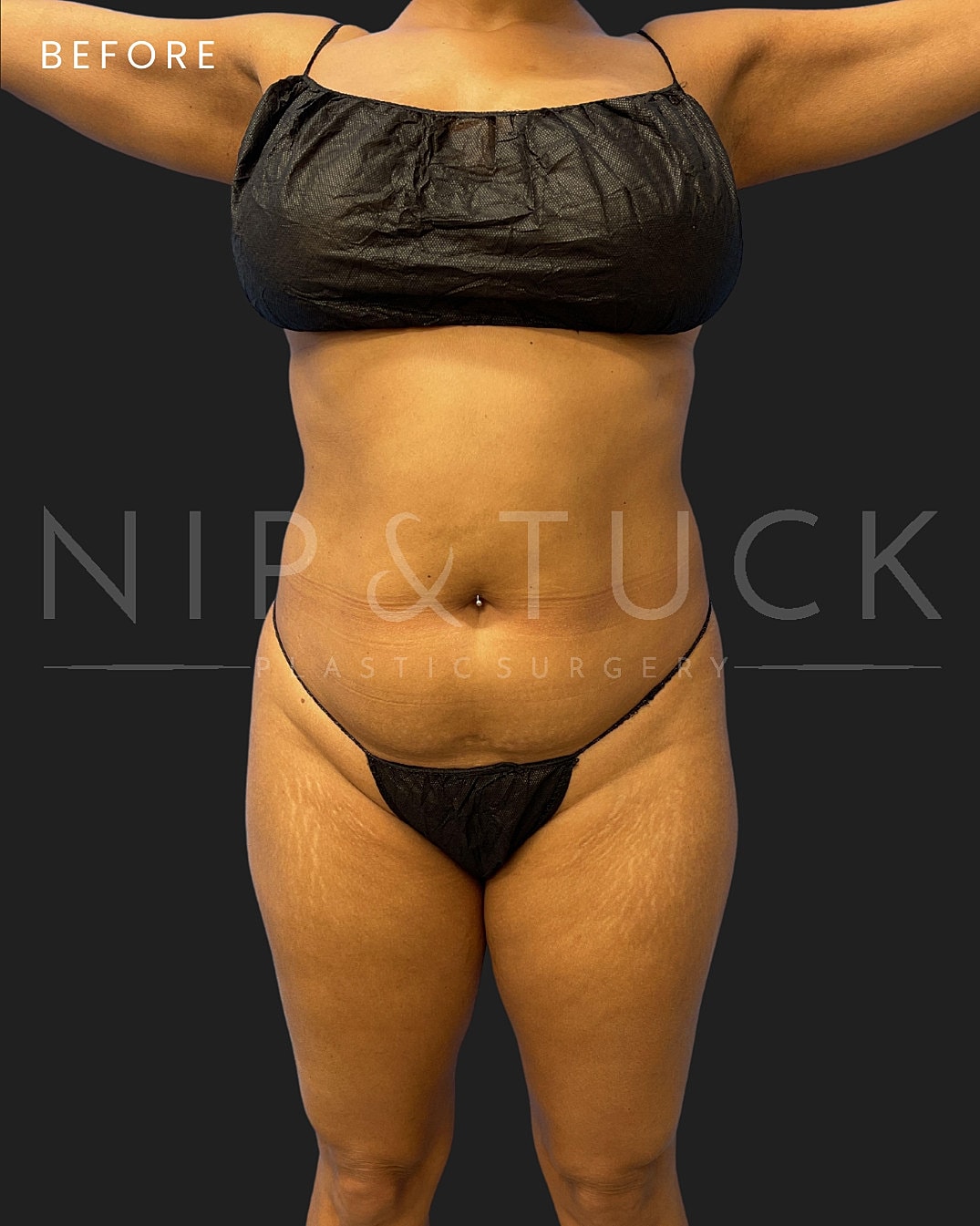 Brazilian Butt Lift Before & After