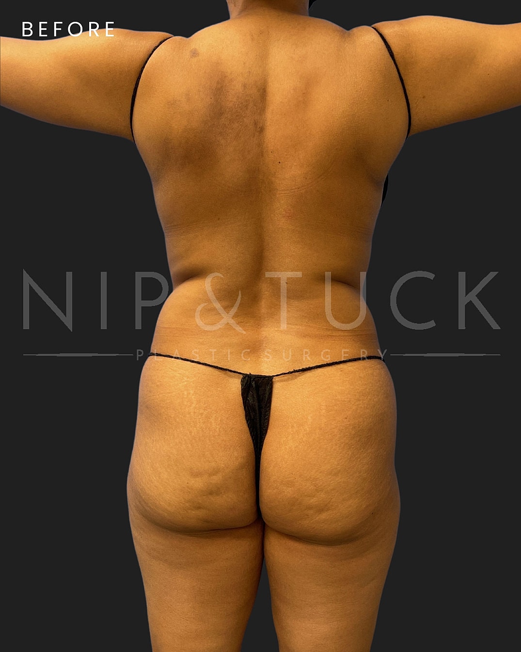 Brazilian Butt Lift Before & After