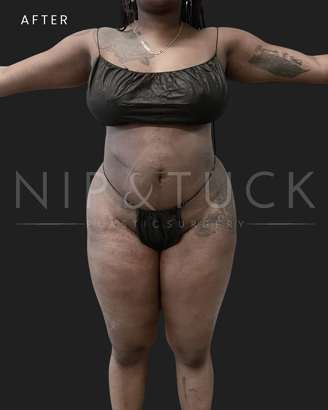 Brazilian Butt Lift Before & After
