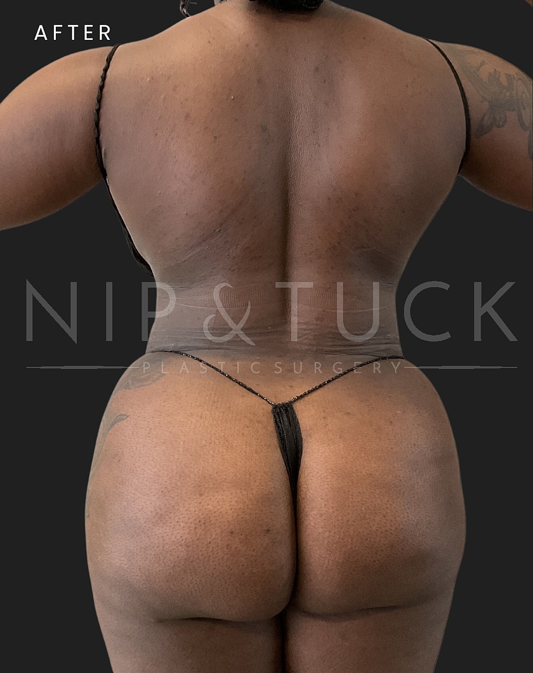 Brazilian Butt Lift Before & After