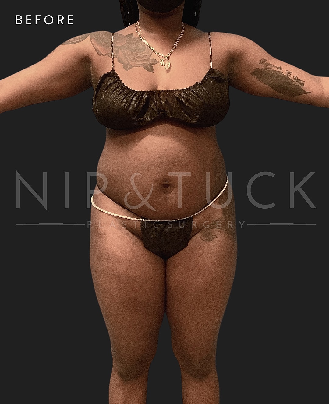 Brazilian Butt Lift Before & After