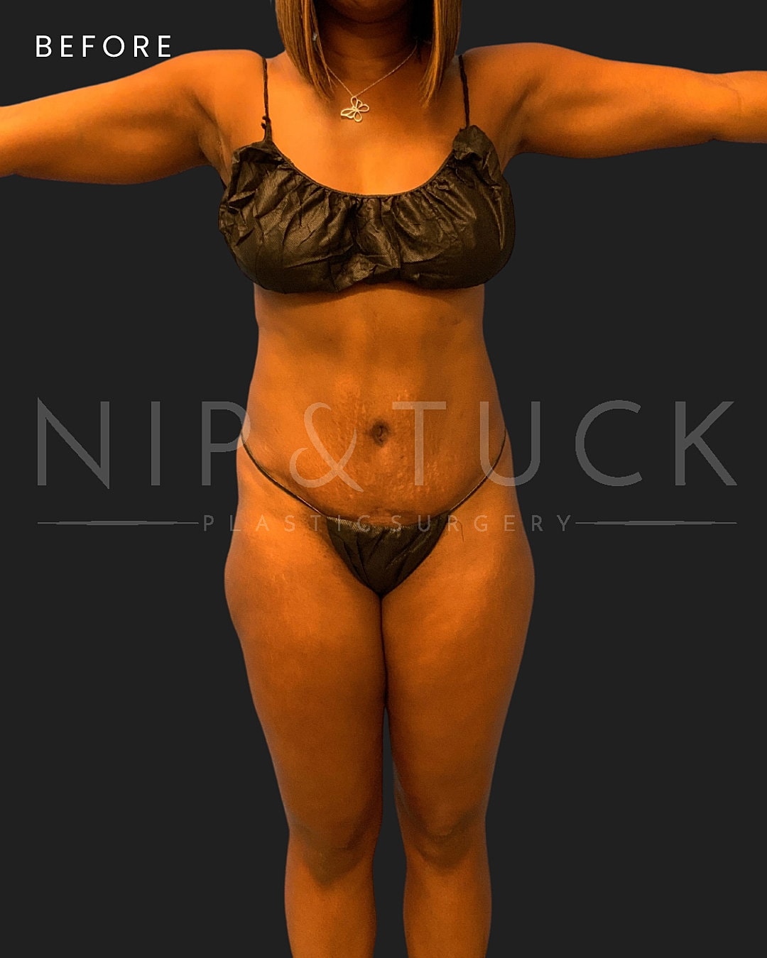 Brazilian Butt Lift Before & After