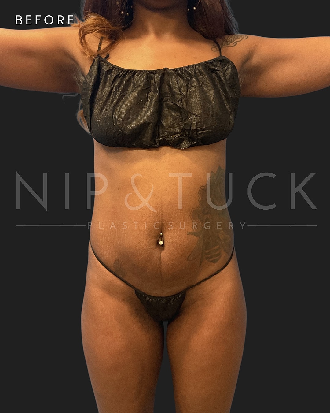 Brazilian Butt Lift Before & After