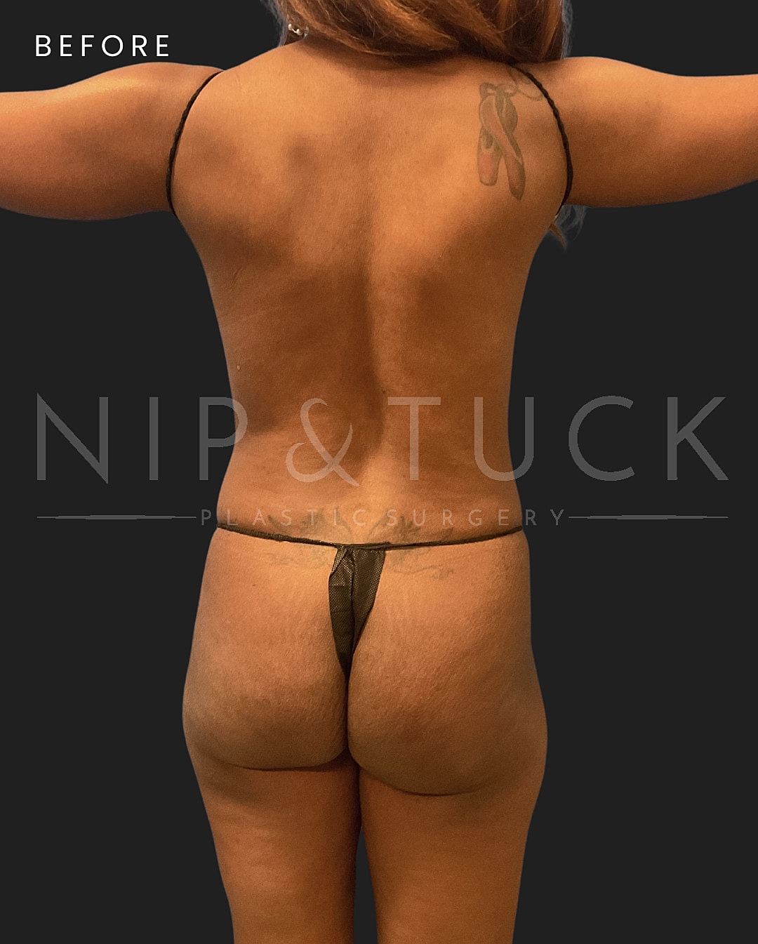 Brazilian Butt Lift Before & After