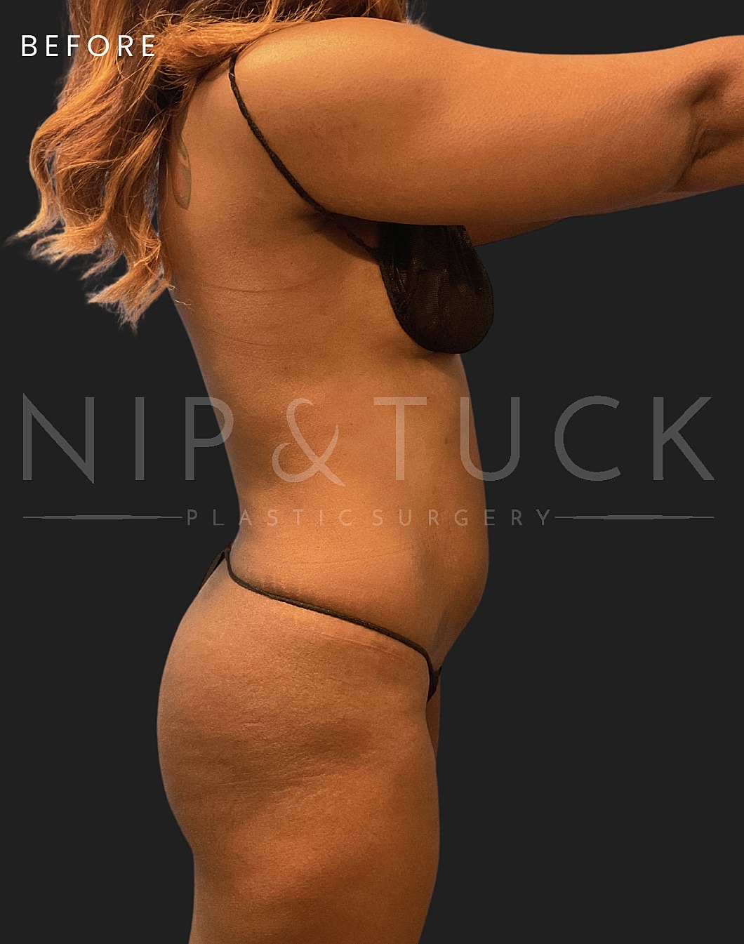 Brazilian Butt Lift Before & After