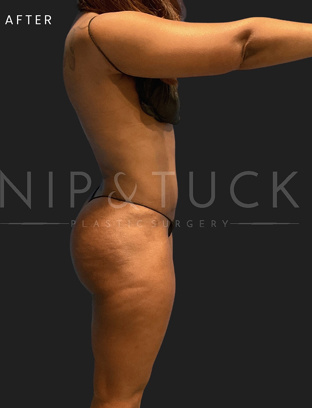 Brazilian Butt Lift Before & After
