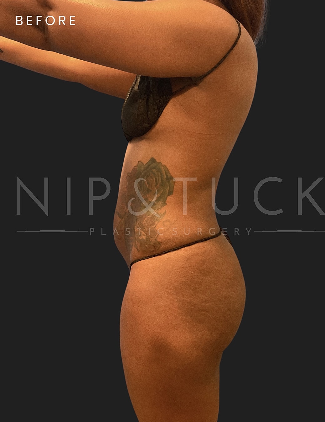 Brazilian Butt Lift Before & After