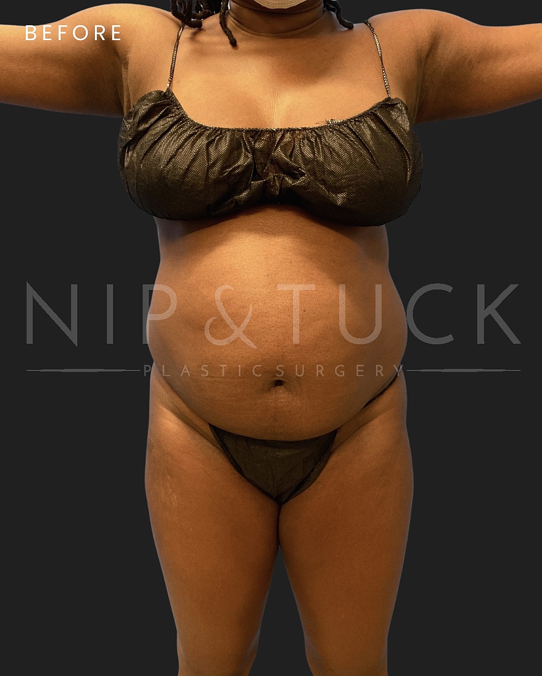 Brazilian Butt Lift Before & After