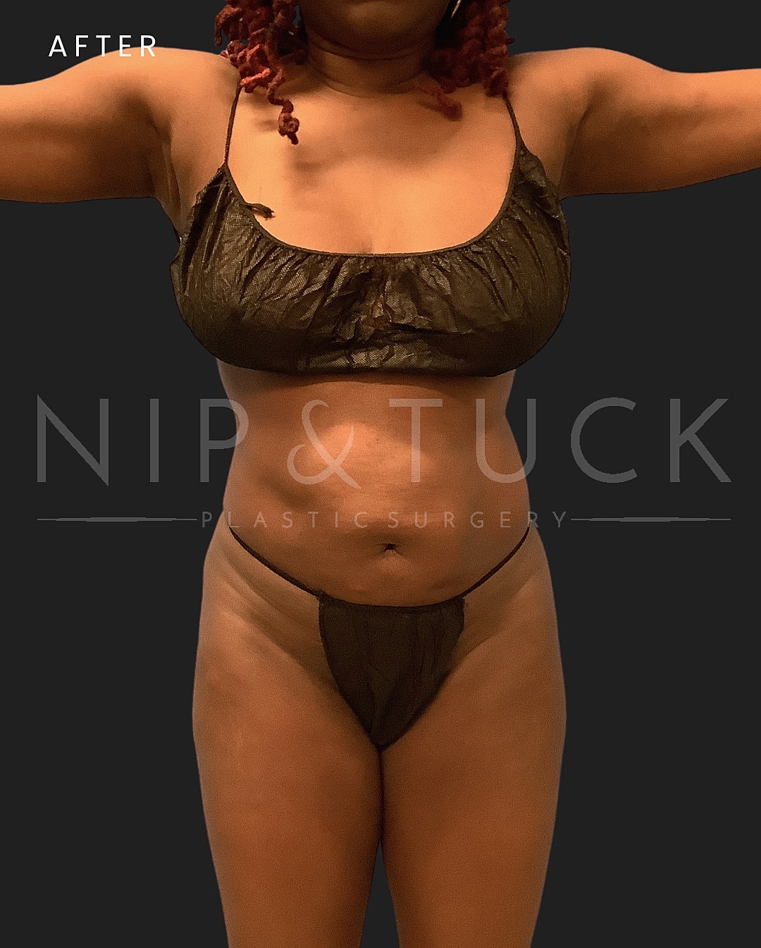 Brazilian Butt Lift Before & After