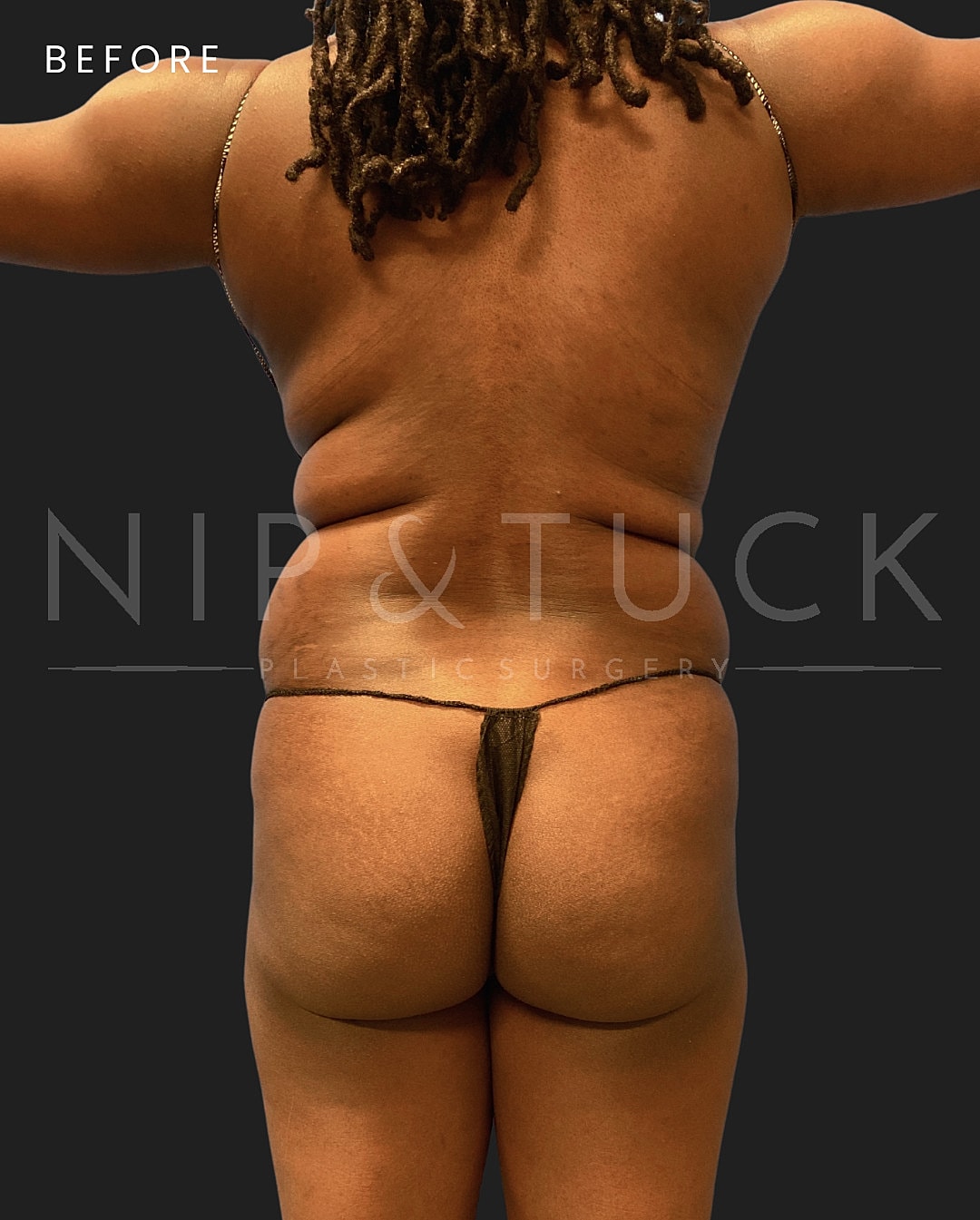 Brazilian Butt Lift Before & After