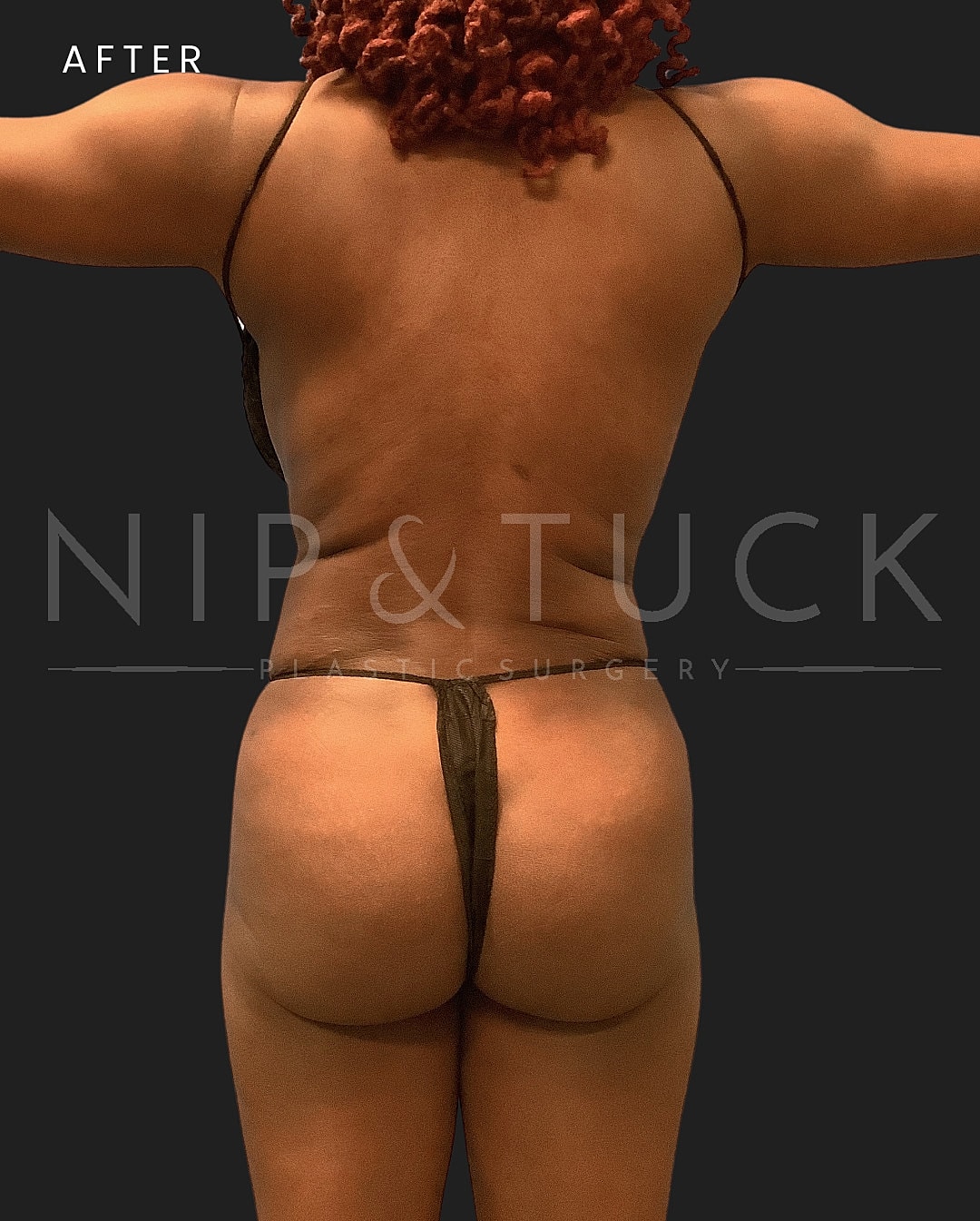 Brazilian Butt Lift Before & After