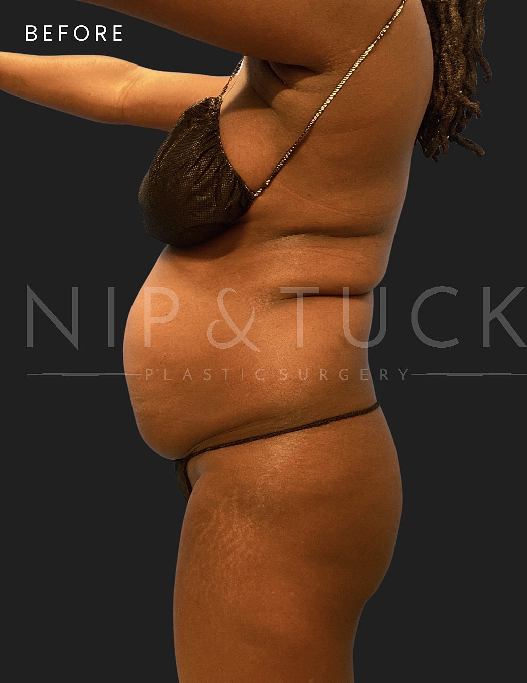 Brazilian Butt Lift Before & After