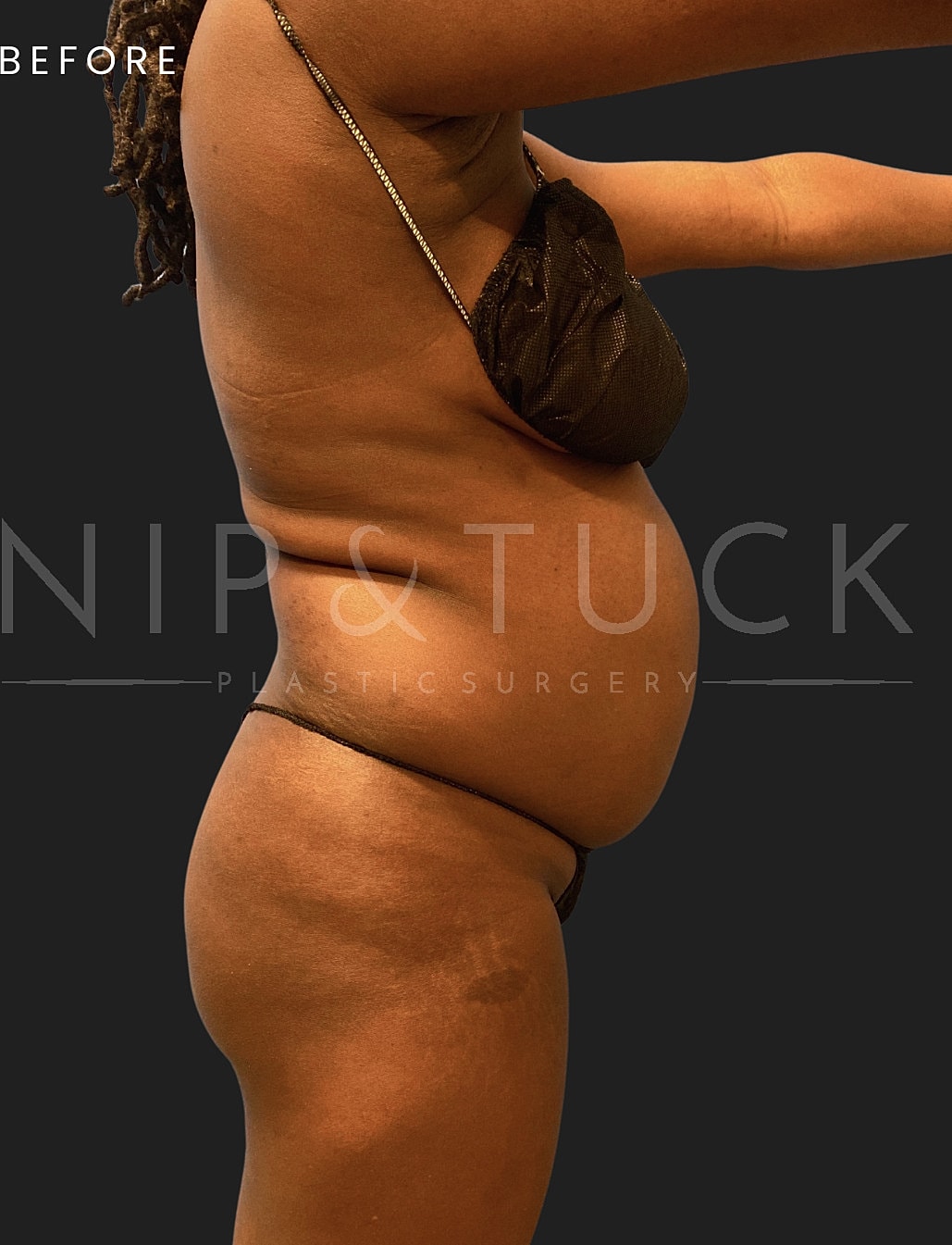 Brazilian Butt Lift Before & After