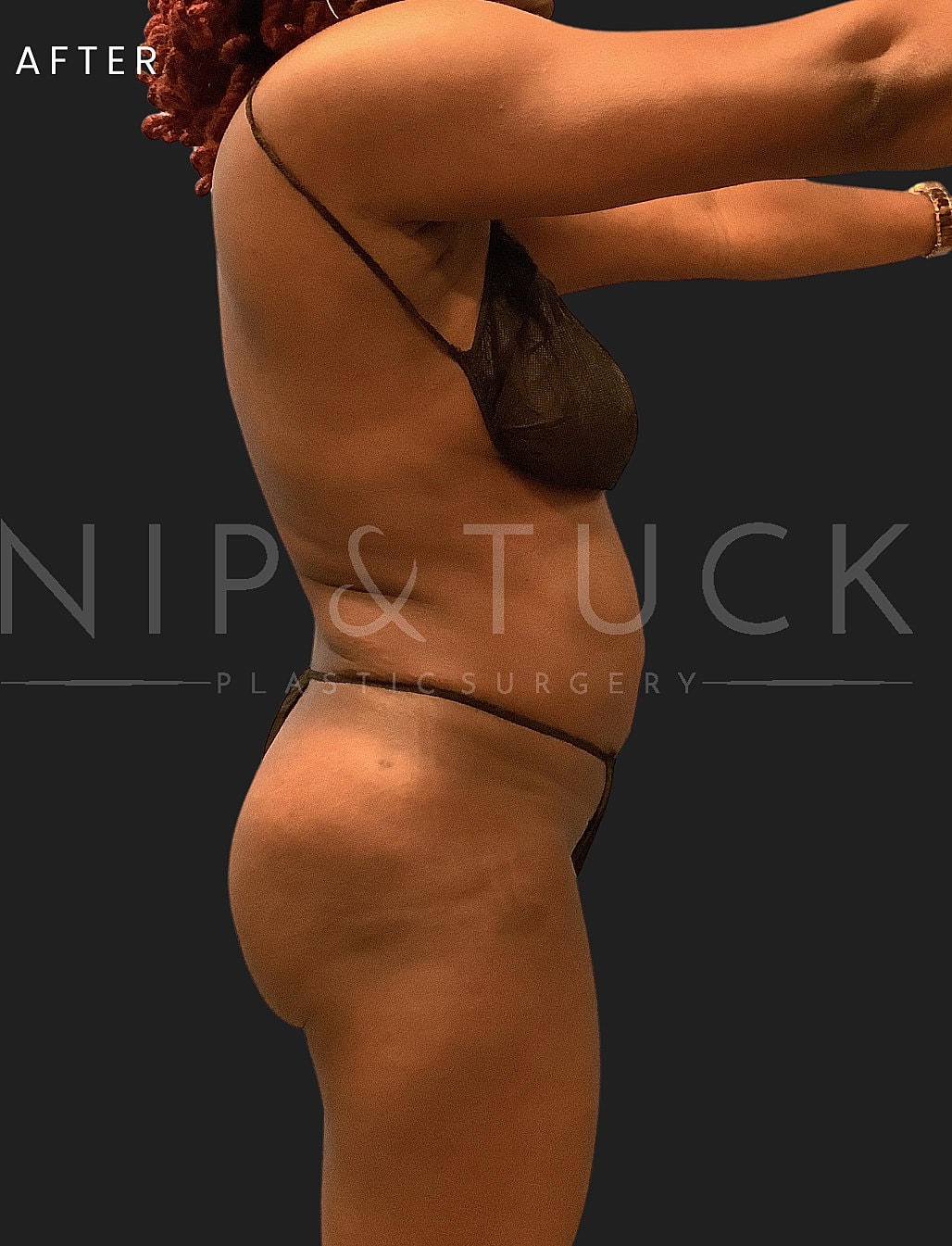 Brazilian Butt Lift Before & After