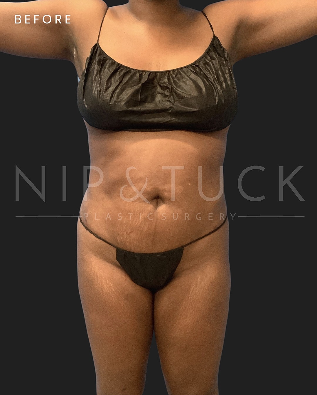 Brazilian Butt Lift Before & After