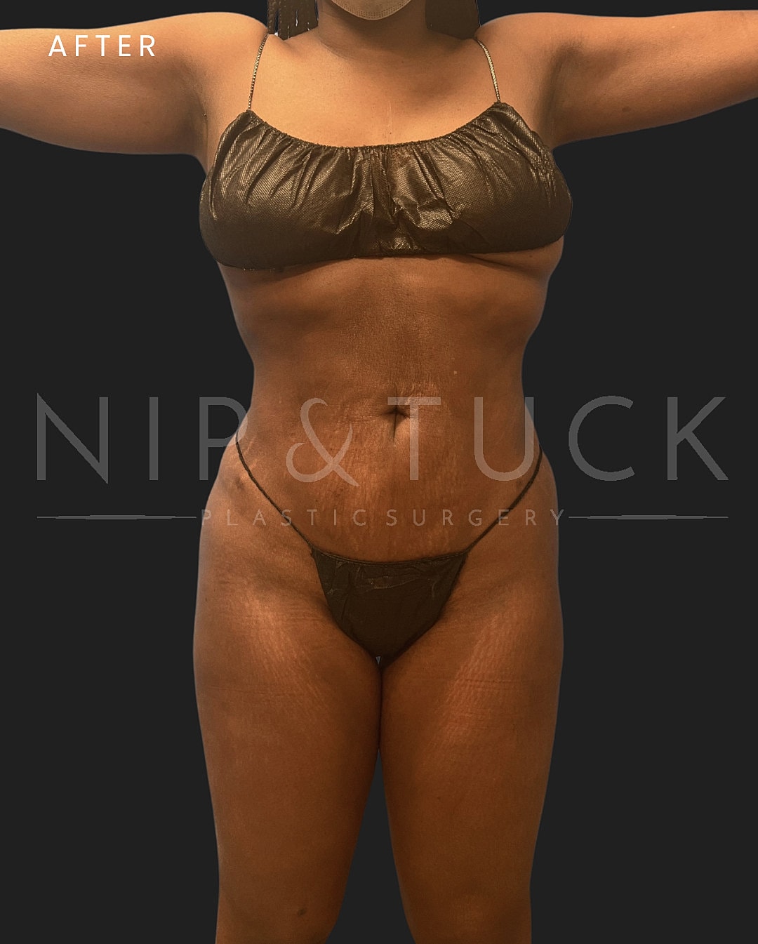 Brazilian Butt Lift Before & After