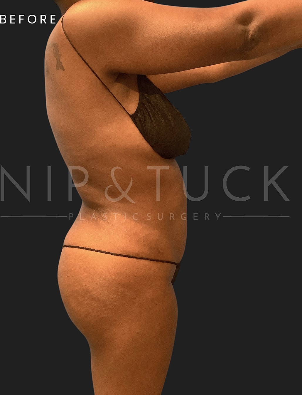 Brazilian Butt Lift Before & After