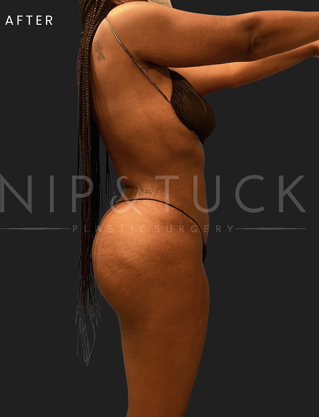 Brazilian Butt Lift Before & After