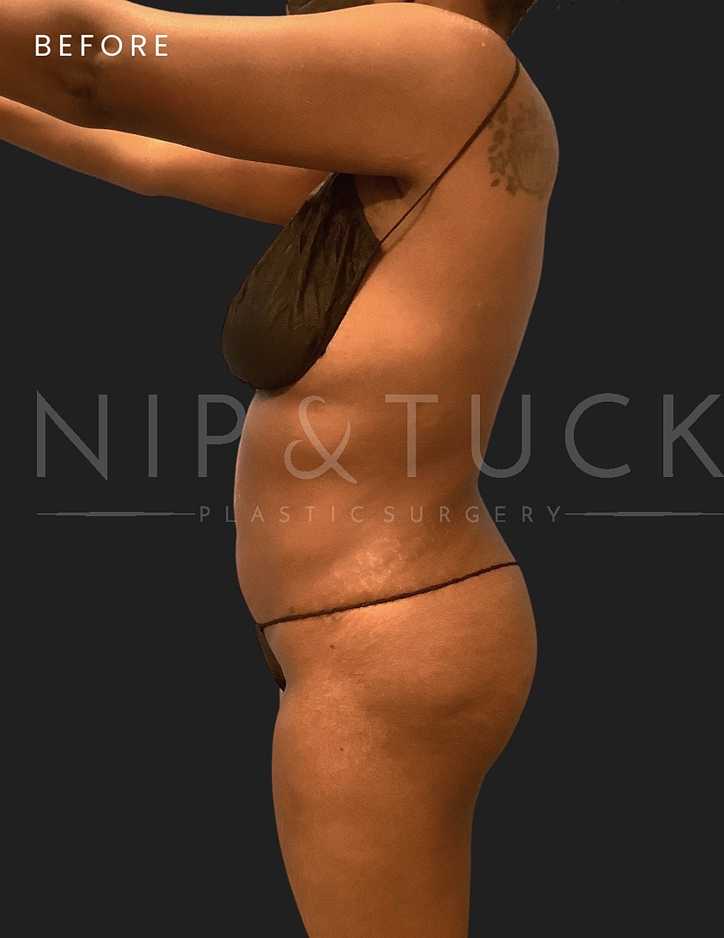 Brazilian Butt Lift Before & After