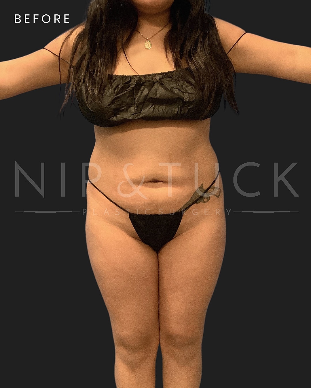 Brazilian Butt Lift Before & After