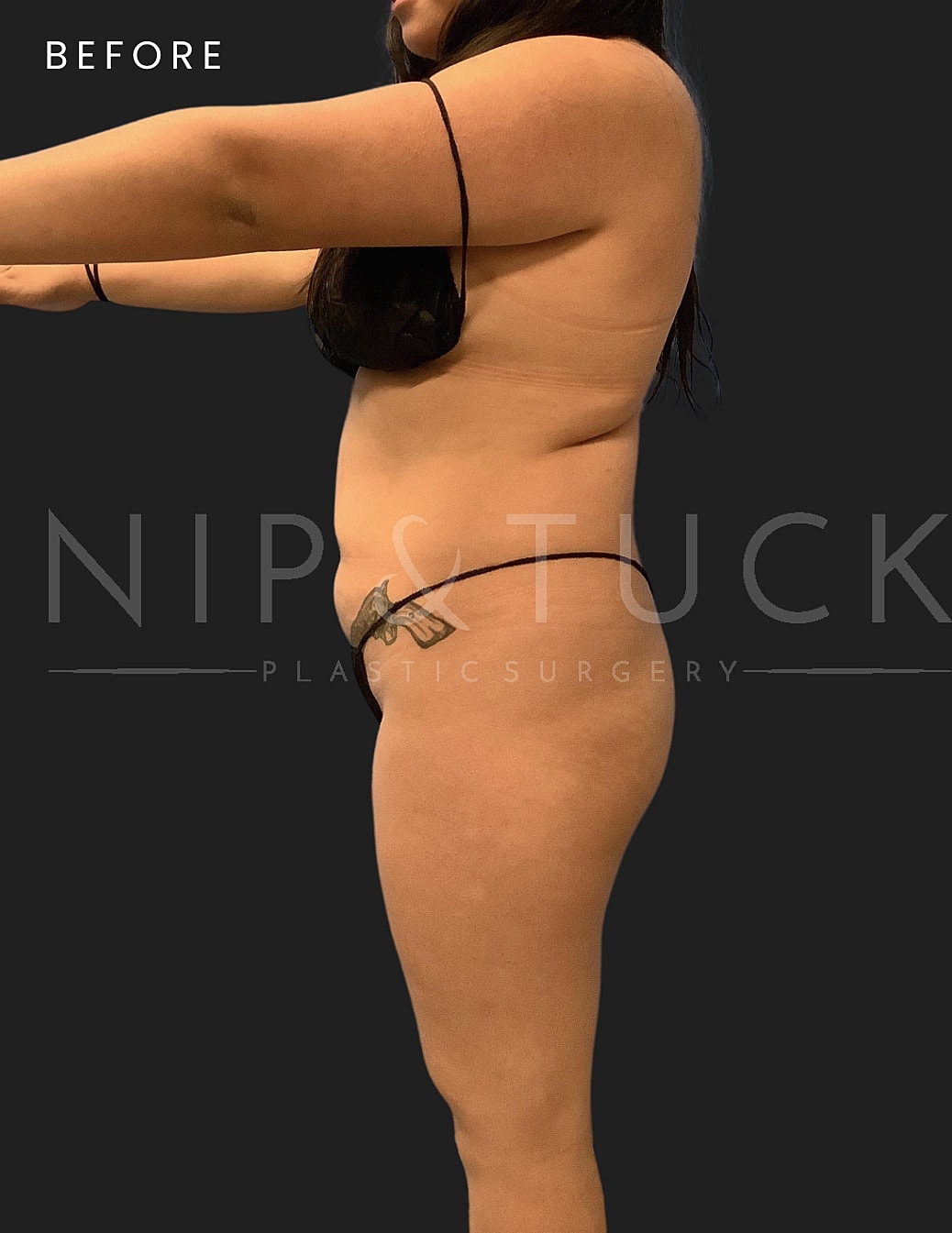 Brazilian Butt Lift Before & After