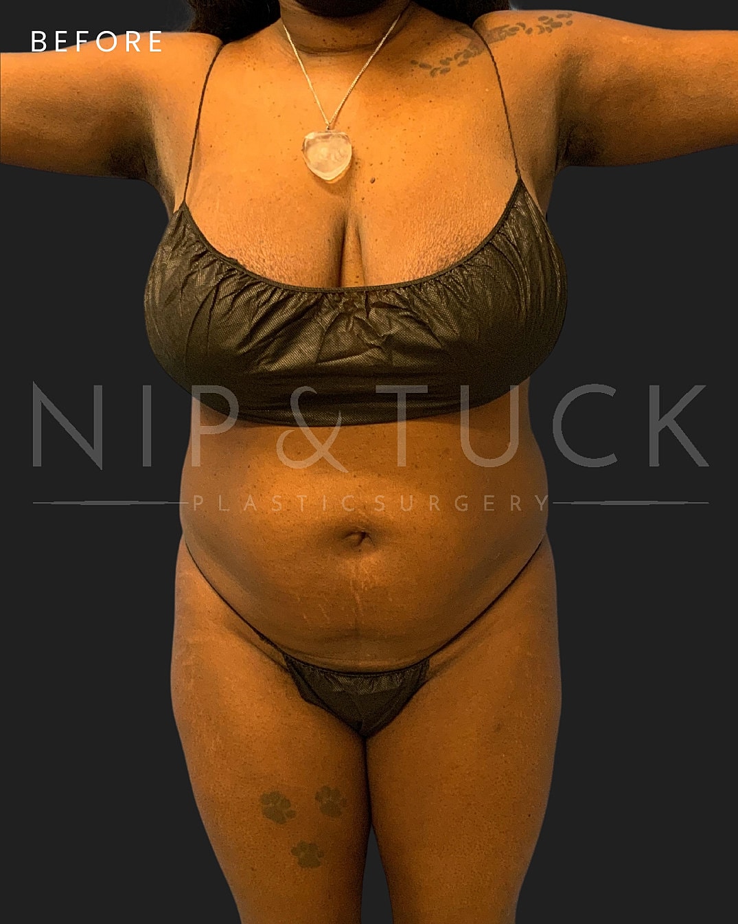 Brazilian Butt Lift Before & After