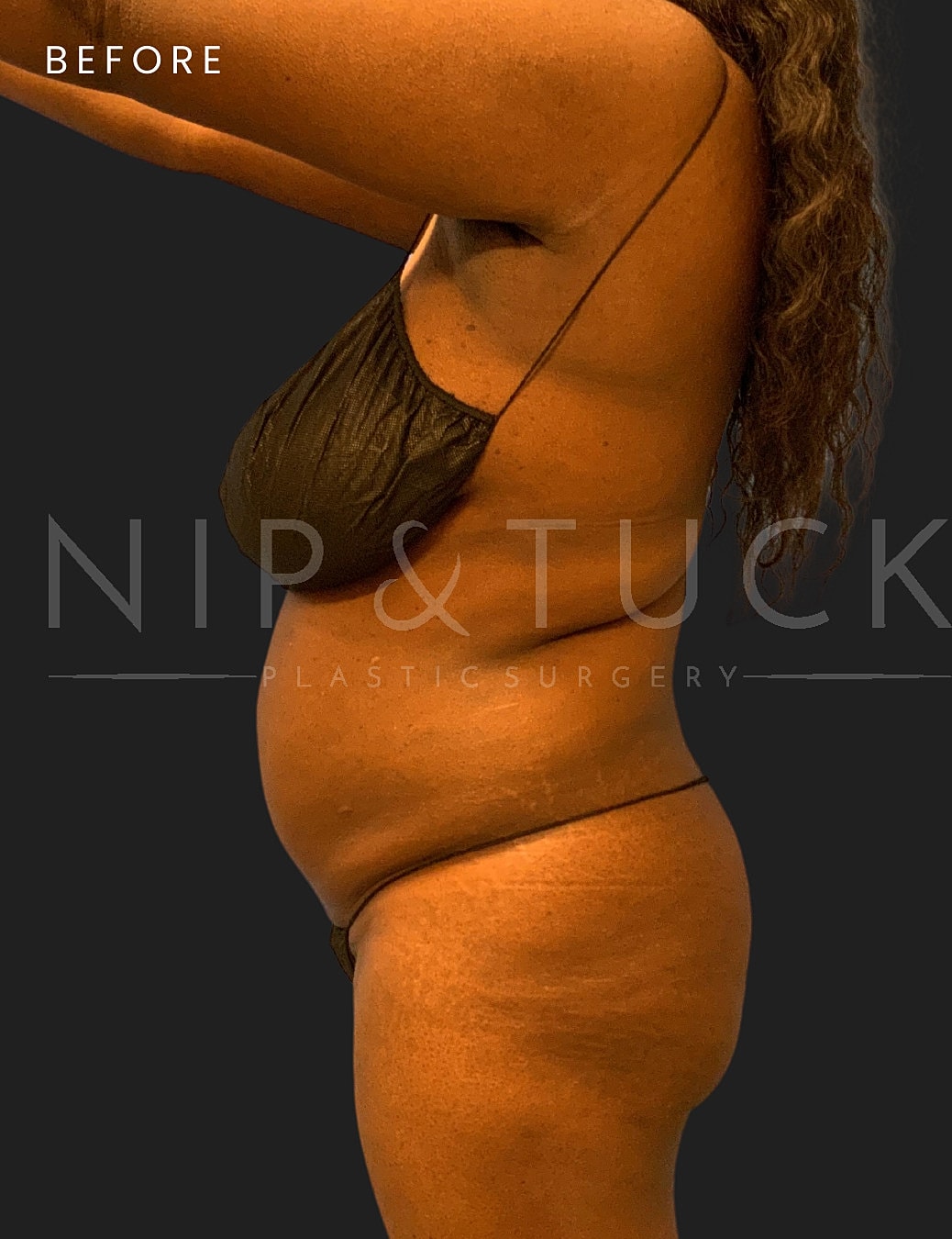 Brazilian Butt Lift Before & After
