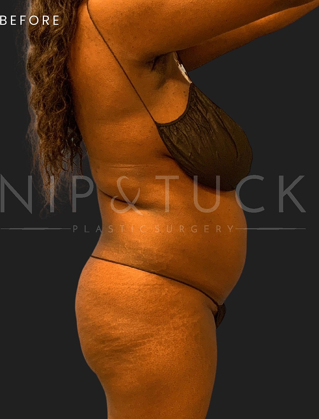 Brazilian Butt Lift Before & After