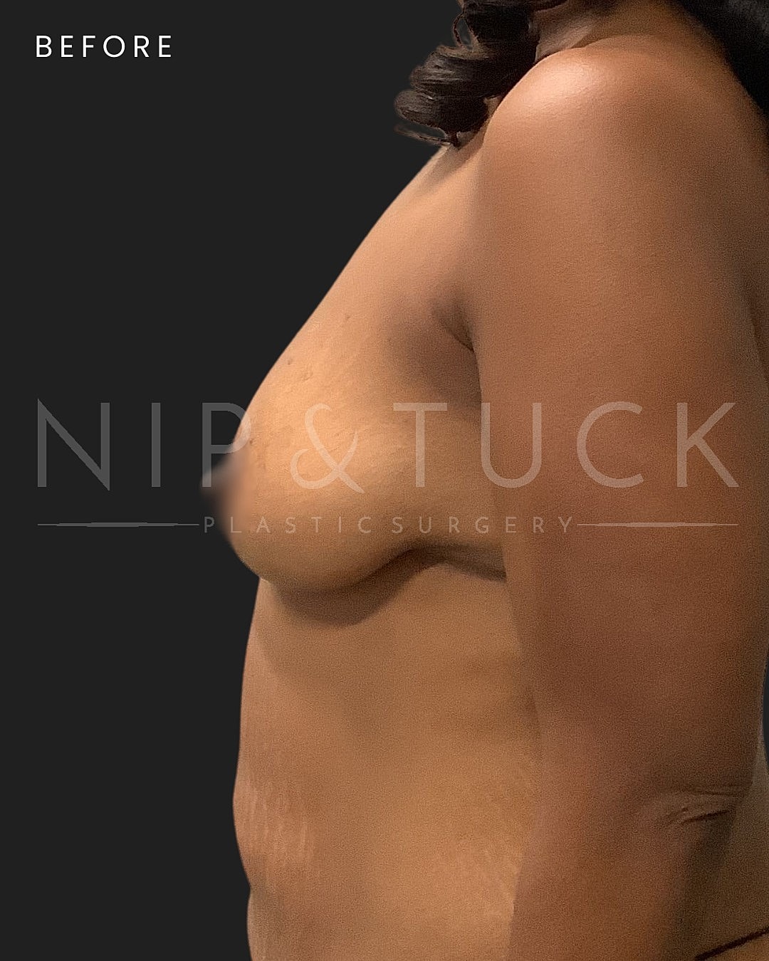 Augmentation Mastopexy Before & After