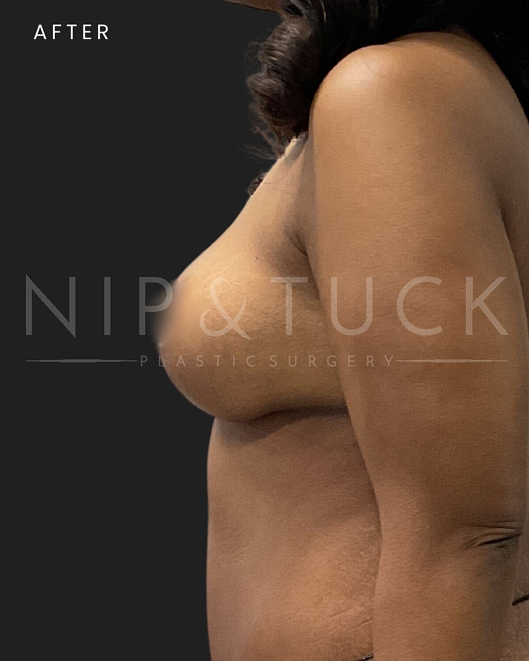 Augmentation Mastopexy Before & After