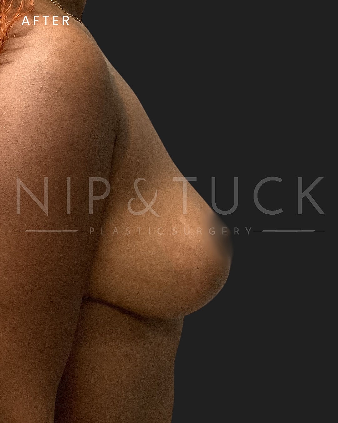 Augmentation Mastopexy Before & After