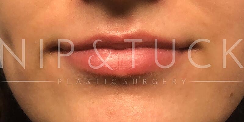 Lip Fillers Before & After