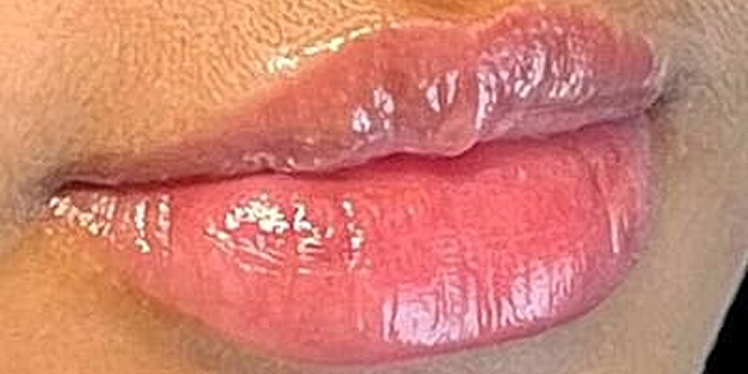 Lip Fillers Before & After