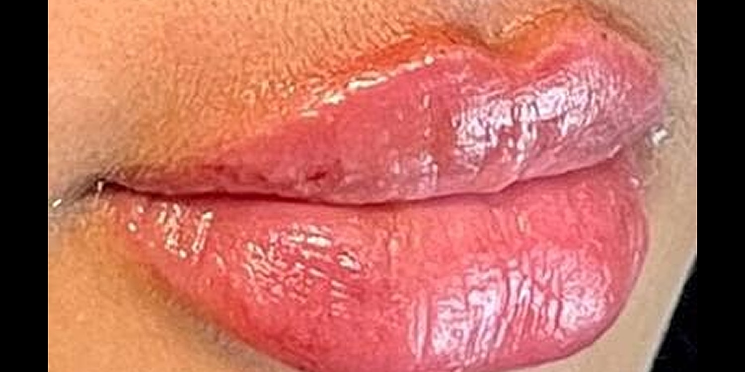 Lip Fillers Before & After