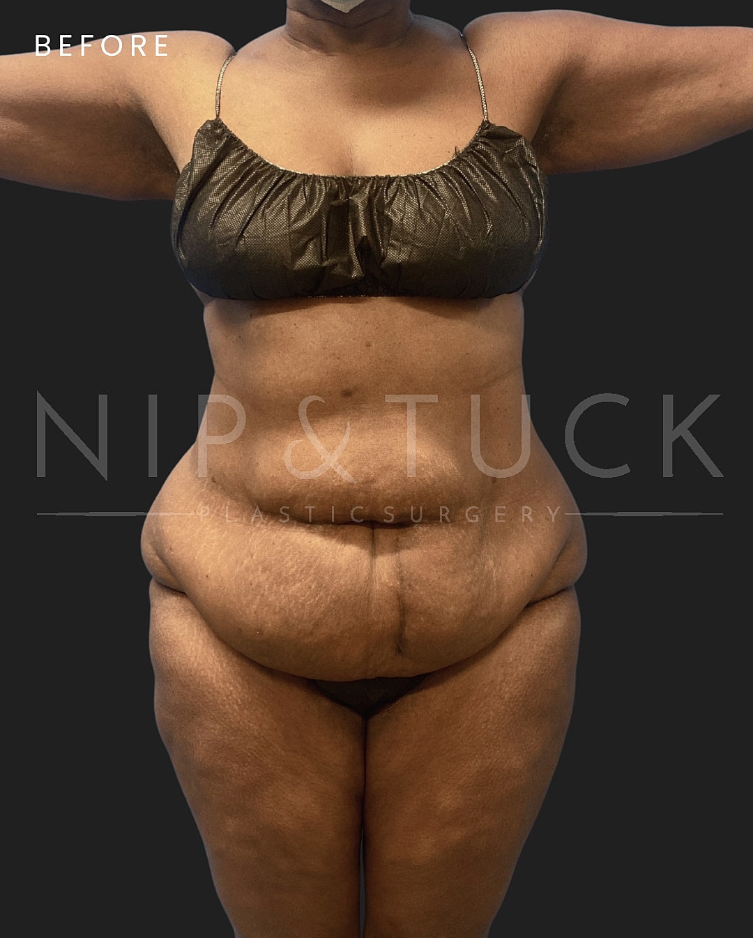 Lower Body Lift Before & After