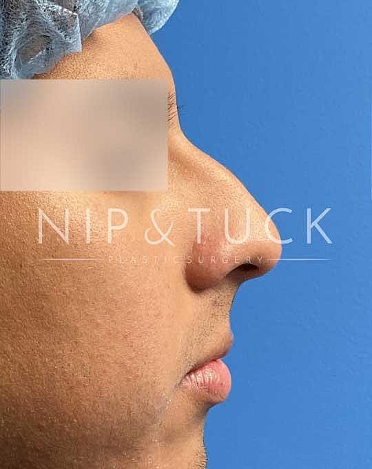 Rhinoplasty Before & After