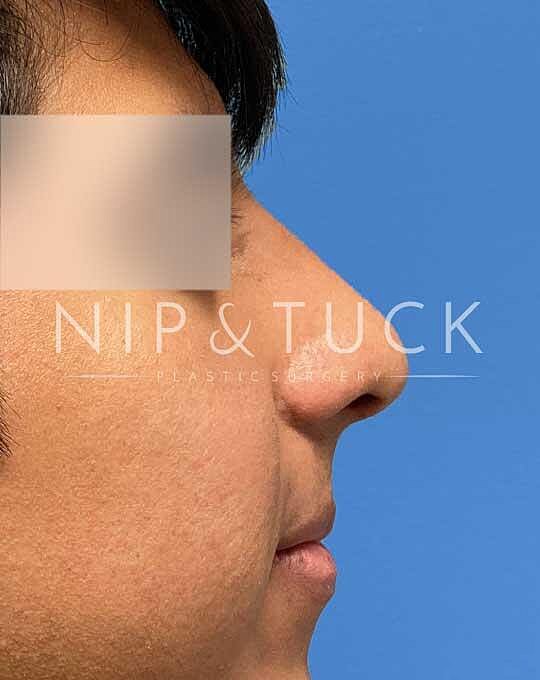 Rhinoplasty Before & After