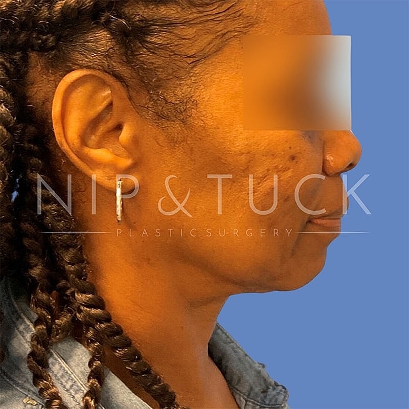 Pdo Threads Before & After